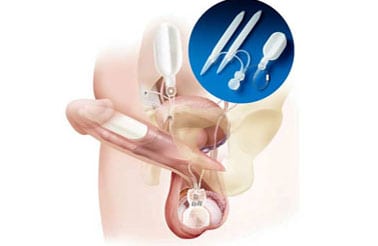 Penile-Prosthesis-Coloplast