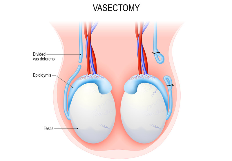 Illustration-of-a-vasectomy