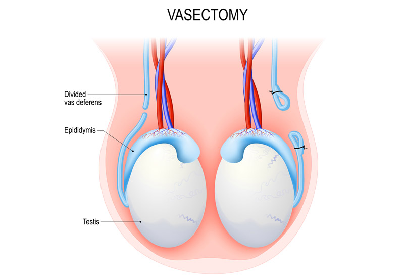 Microscopic-Vasectomy-Reversal-Dr.-Faysal-Yafi