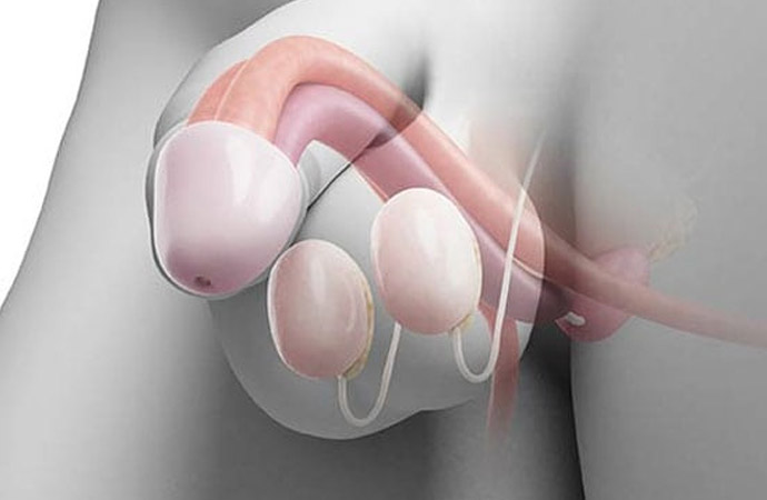 Penile Prosthesis (Coloplast)-Dr.-Faysal-A.-Yafi